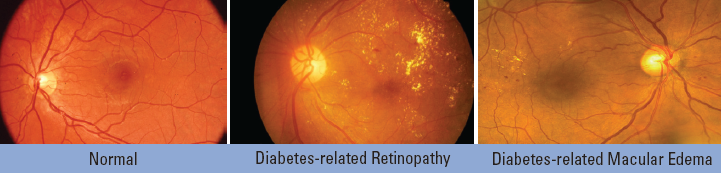 Normal eyes, eyes with diabete-related retinopathy, and eyes with diabetes-related macular edema