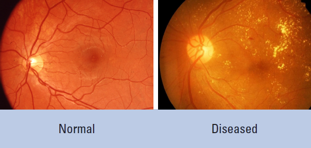 Diabetes-related retinopathy
