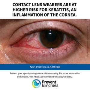 Contact lens wearers are at higher risk for keratitis, an inflammation of the cornea.