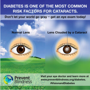 Diabetes is one of the most common risk factors for cataracts.